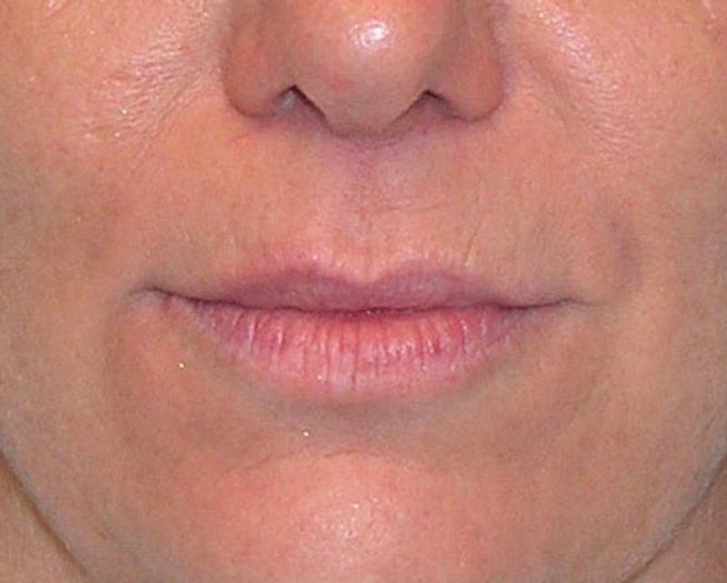 Fillers Before & After Gallery - Patient 518826 - Image 2
