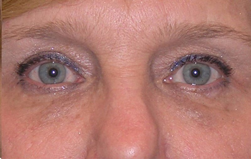 Eyelid Surgery Before & After Gallery - Patient 355305 - Image 2