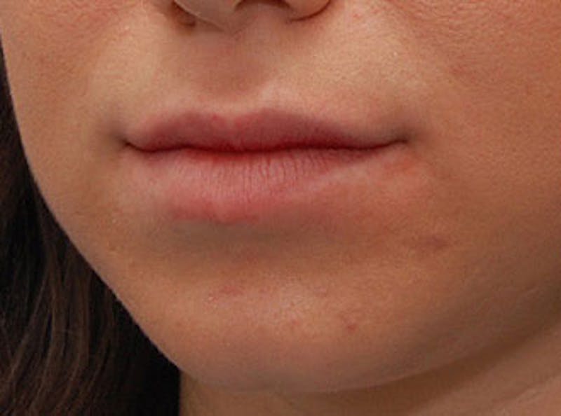 Lip Fillers Before & After Gallery - Patient 304187 - Image 3