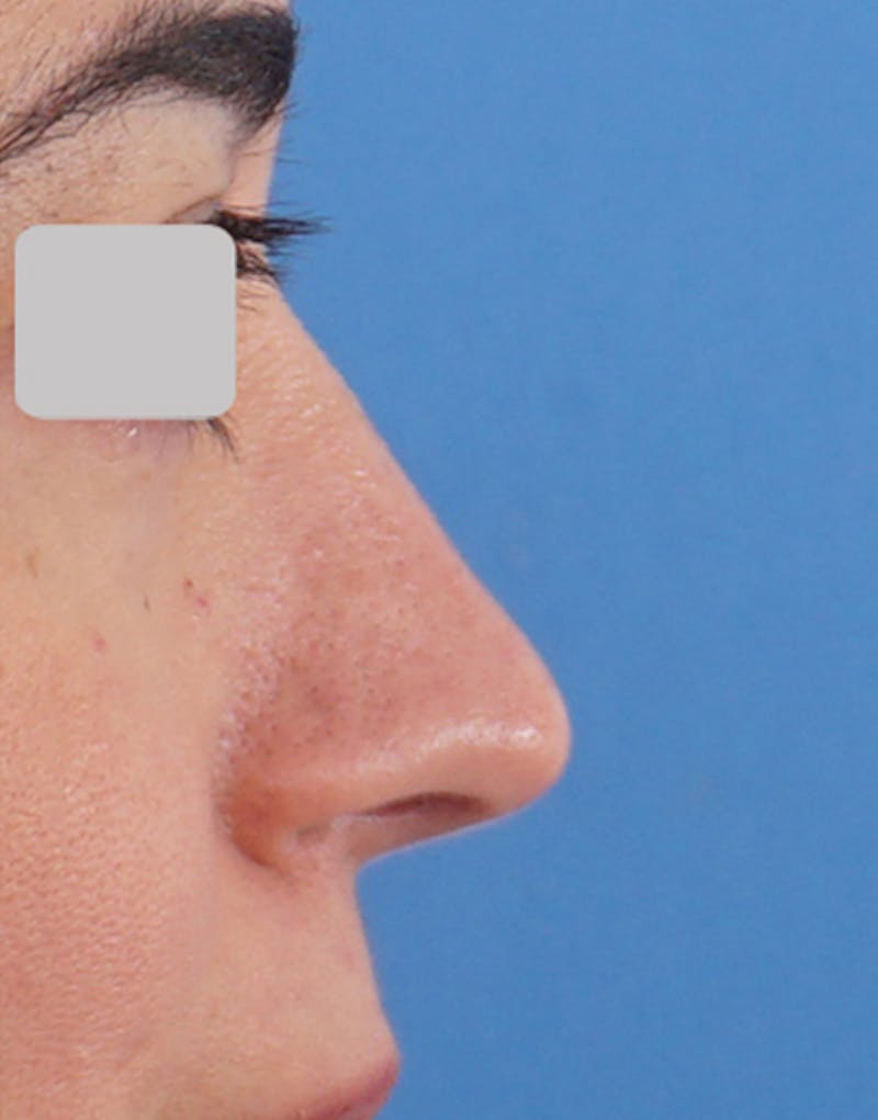 Rhinoplasty Before & After Gallery - Patient 747964 - Image 2