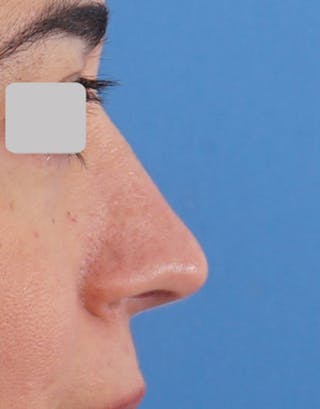 Rhinoplasty Before & After Gallery - Patient 485316 - Image 2