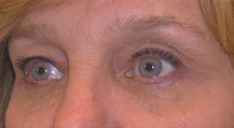 Eyelid Surgery Before & After Gallery - Patient 355305 - Image 3
