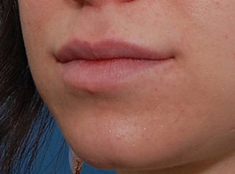 Lip Fillers Before & After Gallery - Patient 304187 - Image 4