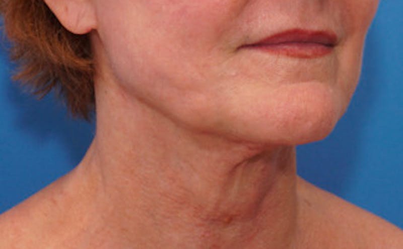 FaceTite Before & After Gallery - Patient 123057 - Image 8