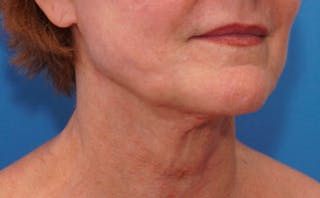 FaceTite Before & After Gallery - Patient 123057 - Image 8
