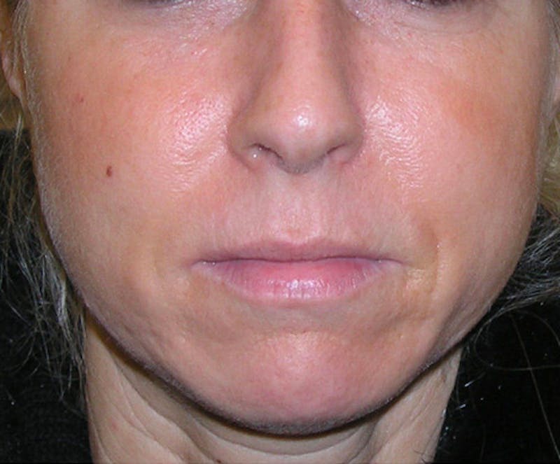 Fillers Before & After Gallery - Patient 392968 - Image 1