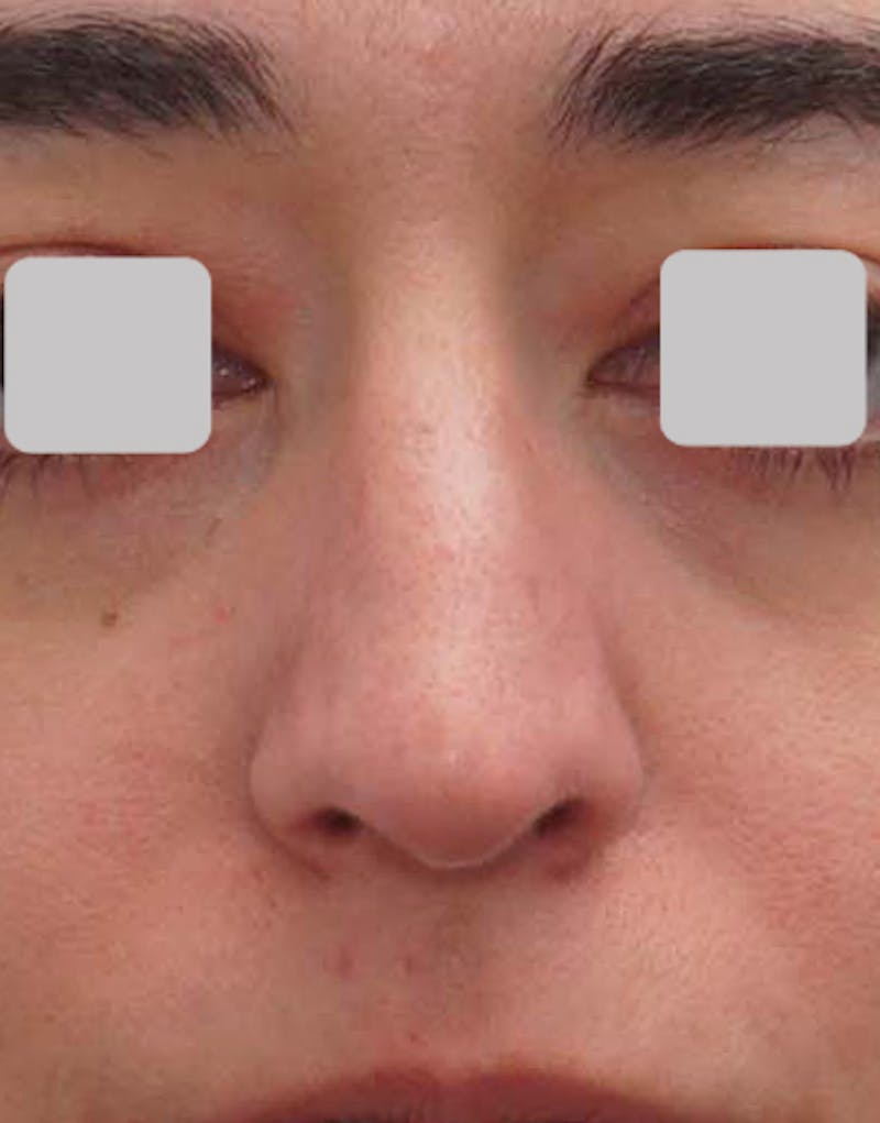 Rhinoplasty  Before & After Gallery - Patient 485316 - Image 3