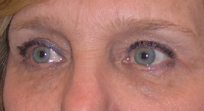 Eyelid Surgery Before & After Gallery - Patient 355305 - Image 4