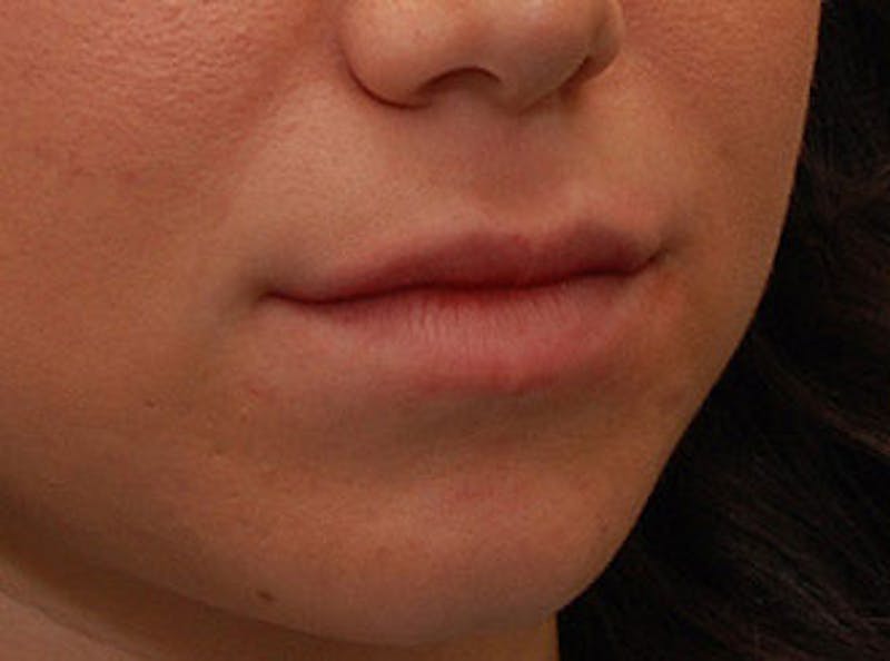 Lip Fillers Before & After Gallery - Patient 304187 - Image 5