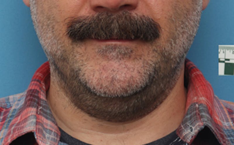 Patient enxUMgGjR_eAMUIDgsI6cQ - FaceTite Before & After Photos