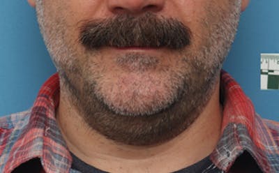 FaceTite Before & After Gallery - Patient 179225 - Image 1