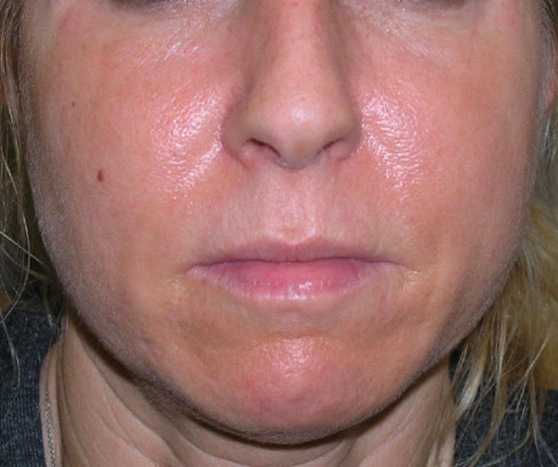 Fillers Before & After Gallery - Patient 392968 - Image 2