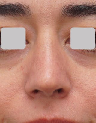 Rhinoplasty Before & After Gallery - Patient 485316 - Image 4