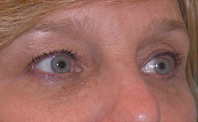 Eyelid Surgery Before & After Gallery - Patient 355305 - Image 5