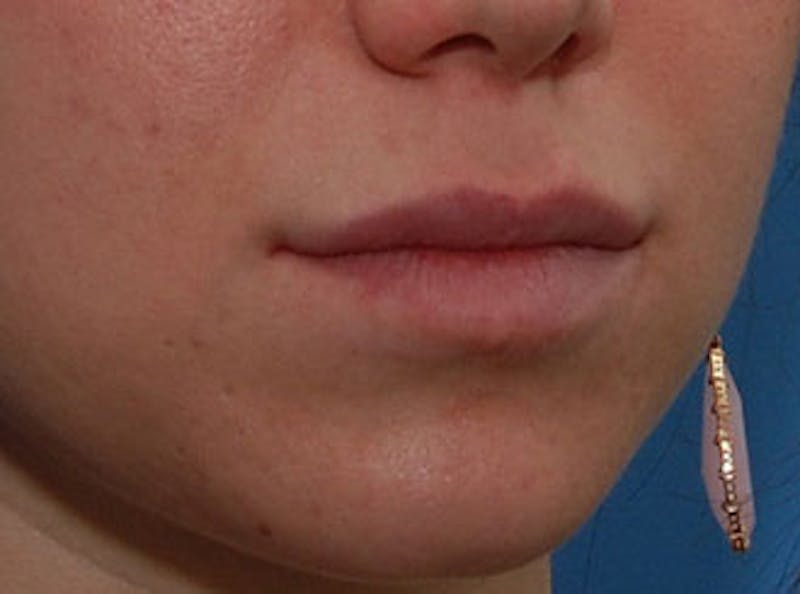 Lip Fillers Before & After Gallery - Patient 304187 - Image 6