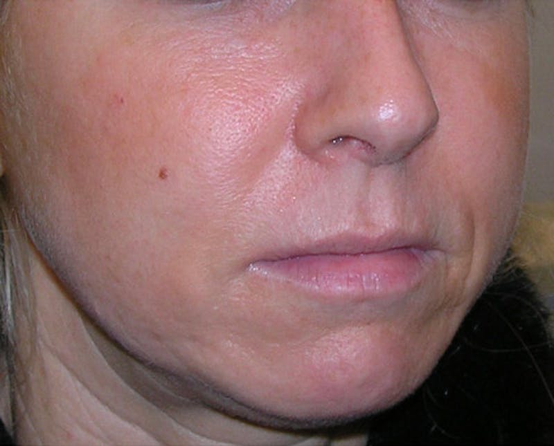 Fillers Before & After Gallery - Patient 392968 - Image 3