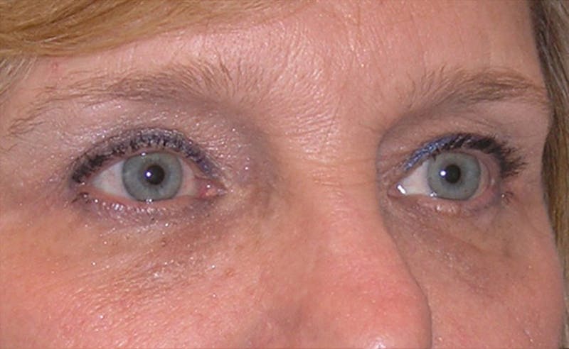 Eyelid Surgery Before & After Gallery - Patient 355305 - Image 6
