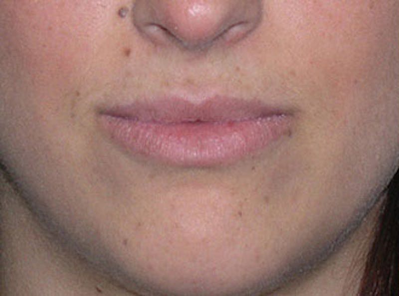 Lip Fillers Before & After Gallery - Patient 451057 - Image 1