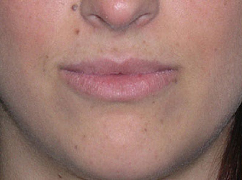 Patient SNva94CDTiK0tU1iblcZXg - Before & After Photos