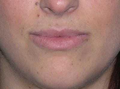 Lip Fillers Before & After Gallery - Patient 451057 - Image 1
