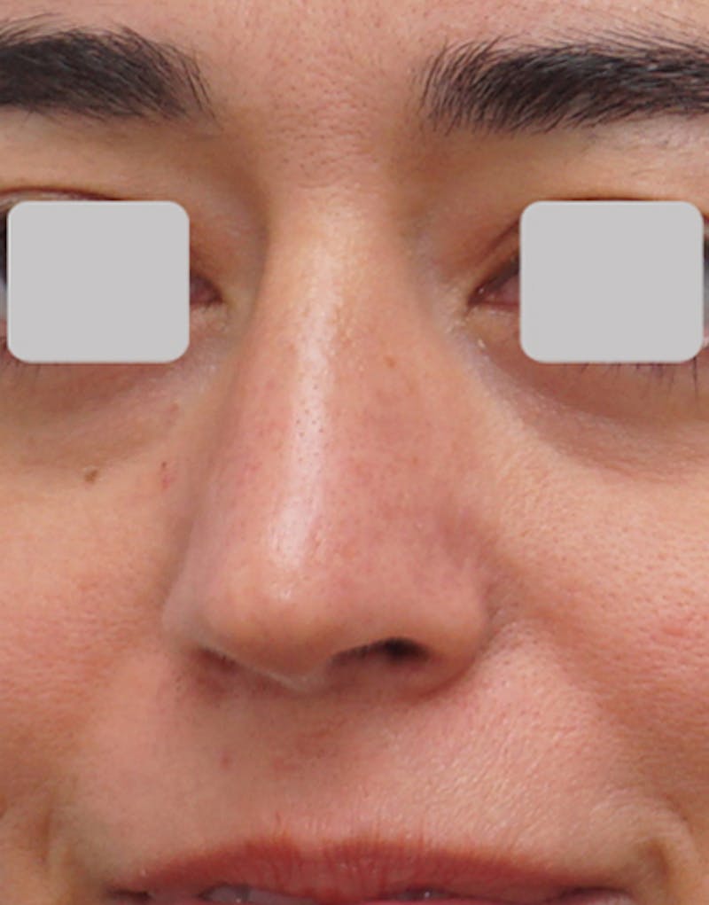 Rhinoplasty  Before & After Gallery - Patient 485316 - Image 6