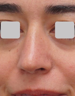 Rhinoplasty Before & After Gallery - Patient 485316 - Image 6