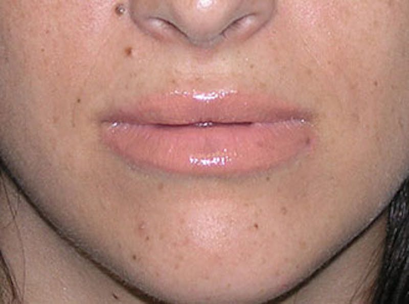 Lip Fillers Before & After Gallery - Patient 451057 - Image 2