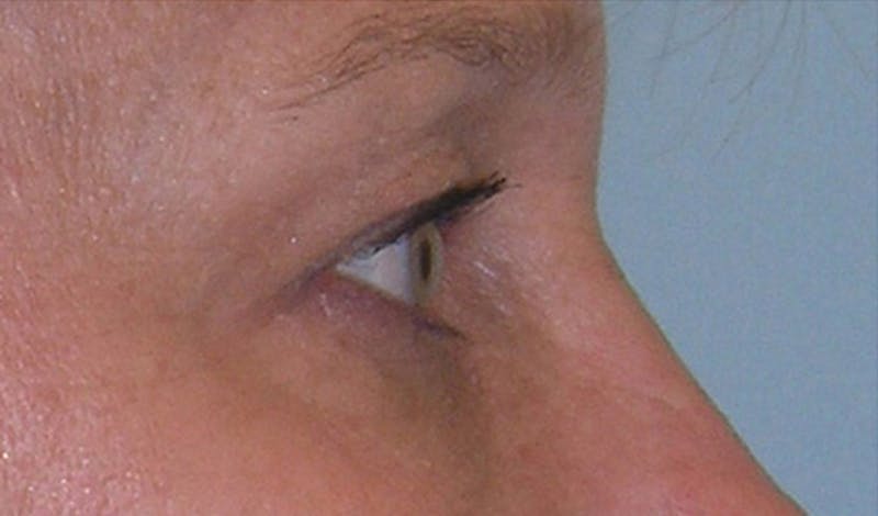 Eyelid Surgery Before & After Gallery - Patient 355305 - Image 7