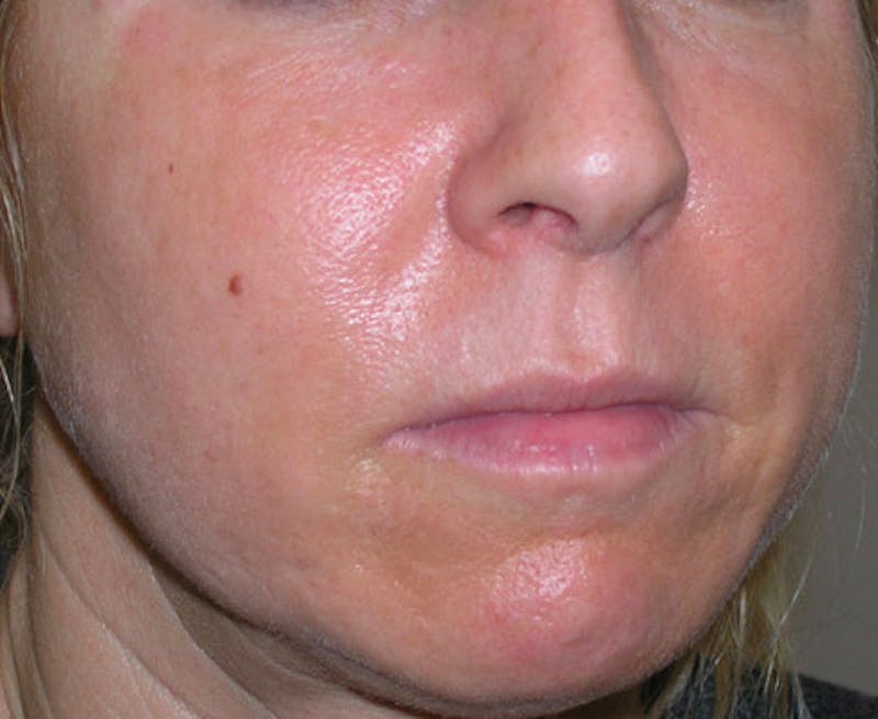 Fillers Before & After Gallery - Patient 392968 - Image 4