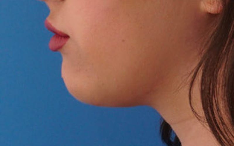 Chin Surgery Before & After Gallery - Patient 184973 - Image 2
