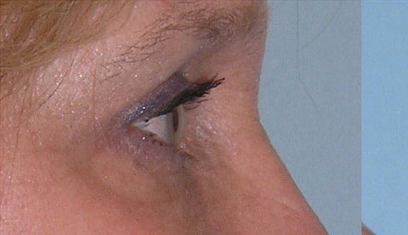 Eyelid Surgery Before & After Gallery - Patient 355305 - Image 8