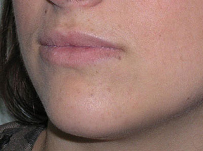 Lip Fillers Before & After Gallery - Patient 451057 - Image 3