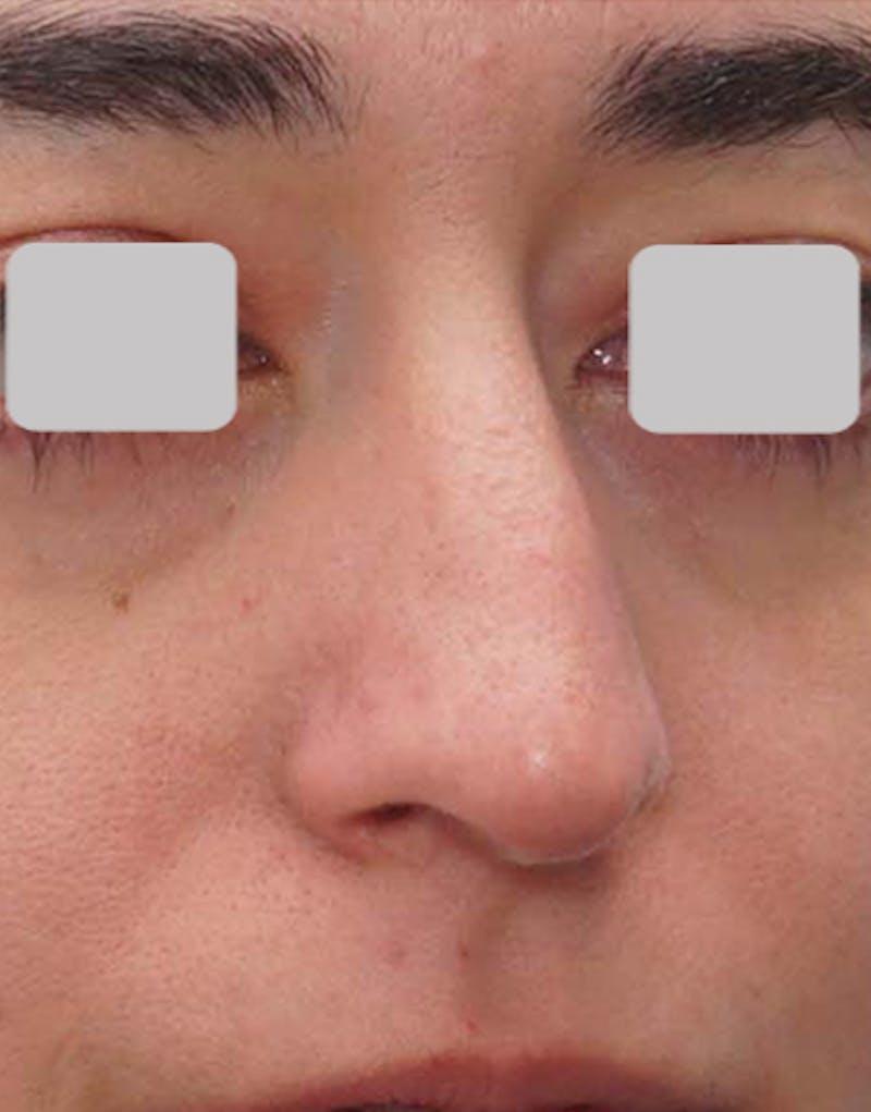 Rhinoplasty  Before & After Gallery - Patient 485316 - Image 7
