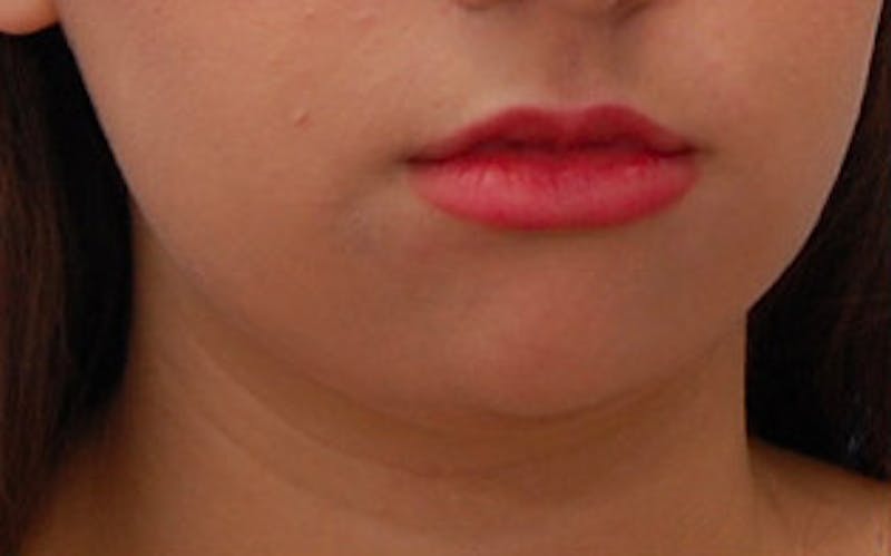 Chin Surgery Before & After Gallery - Patient 184973 - Image 3