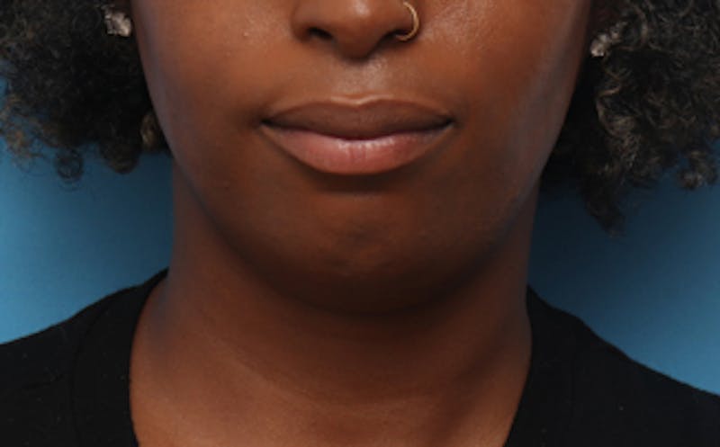 Patient YZqG5_D5SWmAQoM-sm3rTg - Fillers Before & After Photos