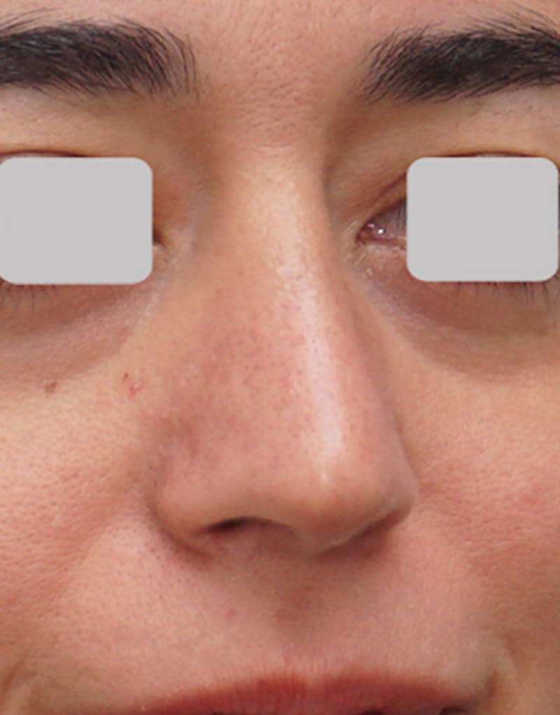 Rhinoplasty  Before & After Gallery - Patient 485316 - Image 8