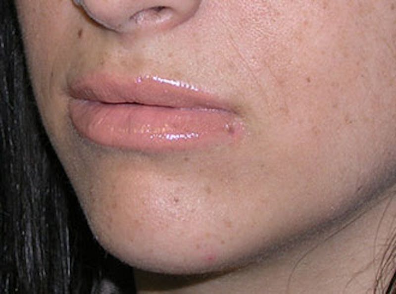 Lip Fillers Before & After Gallery - Patient 451057 - Image 4