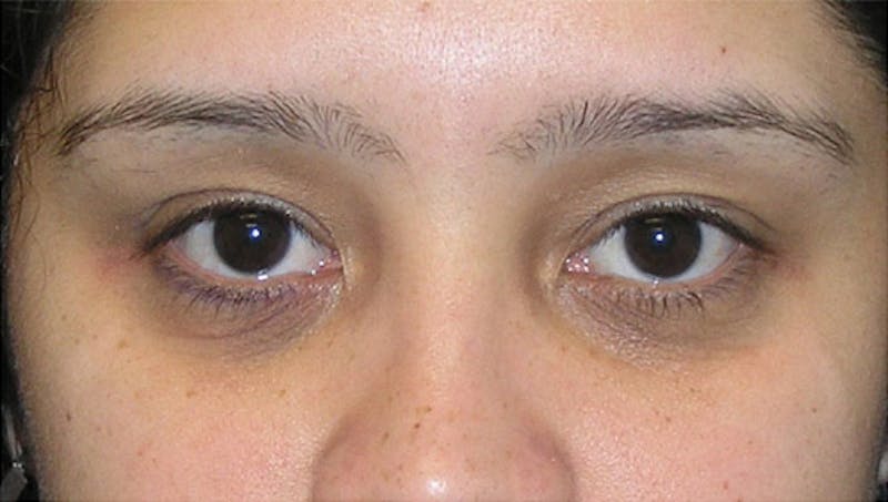 Eyelid Surgery Before & After Gallery - Patient 117908 - Image 1