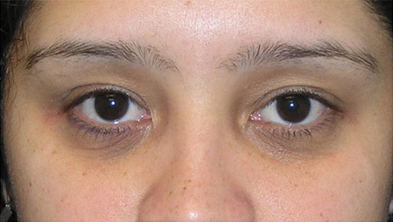 Patient QPvOFBUkRRqXDN1UQBv8bw - Eyelid Surgery Before & After Photos