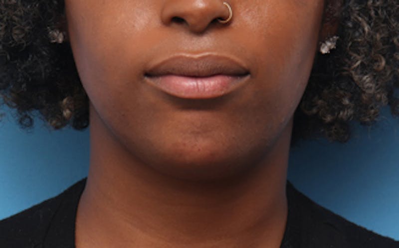 Fillers Before & After Gallery - Patient 313879 - Image 2