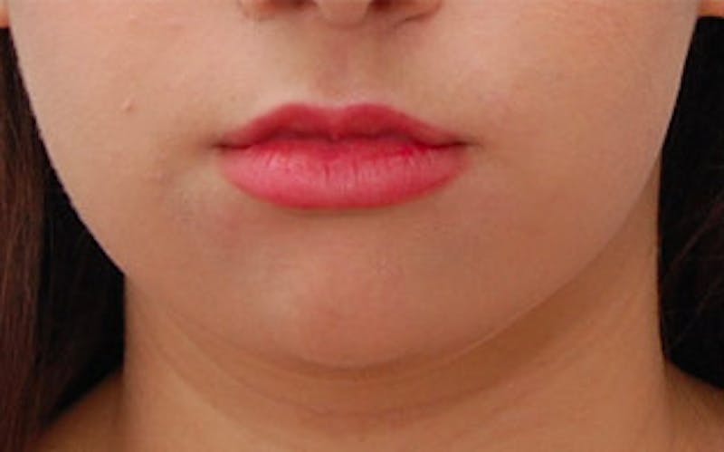 Chin Surgery Before & After Gallery - Patient 184973 - Image 5