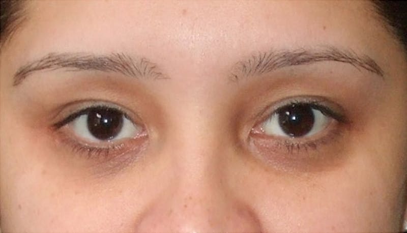 Eyelid Surgery Before & After Gallery - Patient 117908 - Image 2