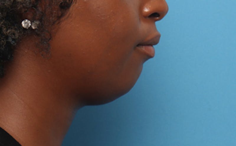 Fillers Before & After Gallery - Patient 313879 - Image 3