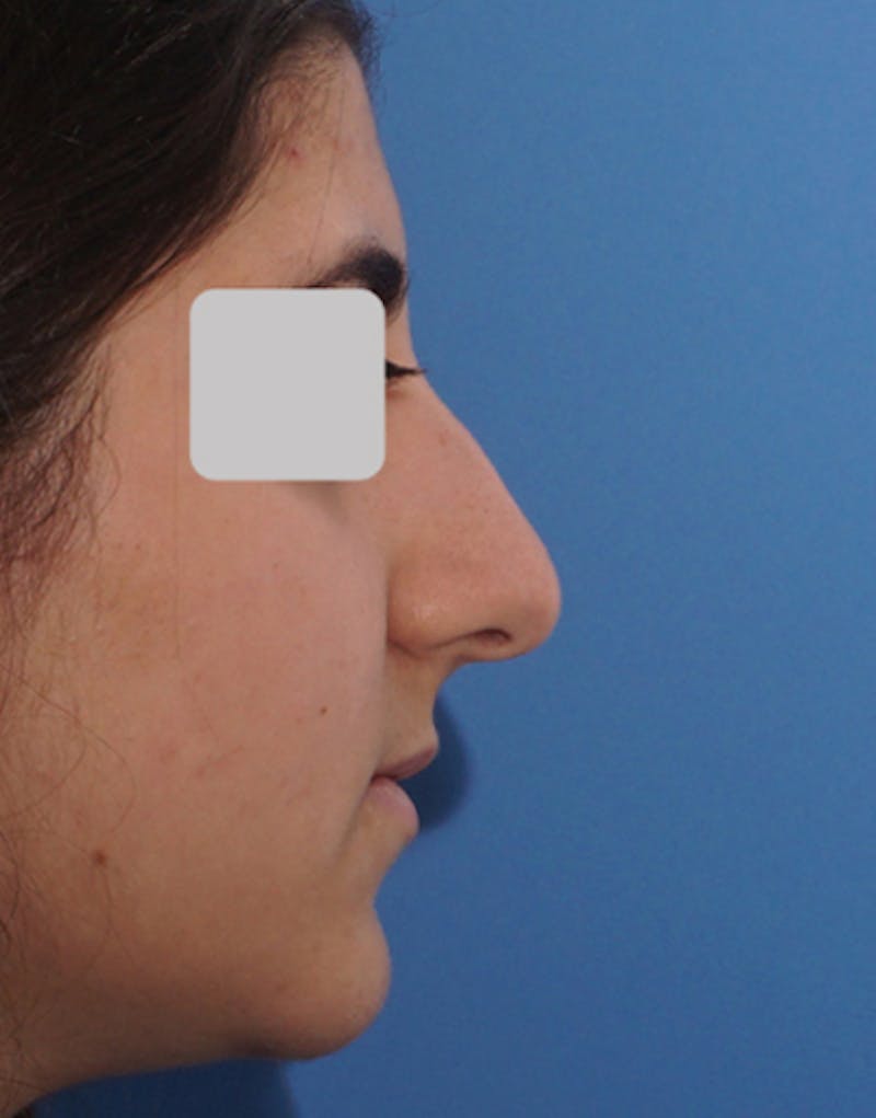 Rhinoplasty Before & After Gallery - Patient 740745 - Image 1