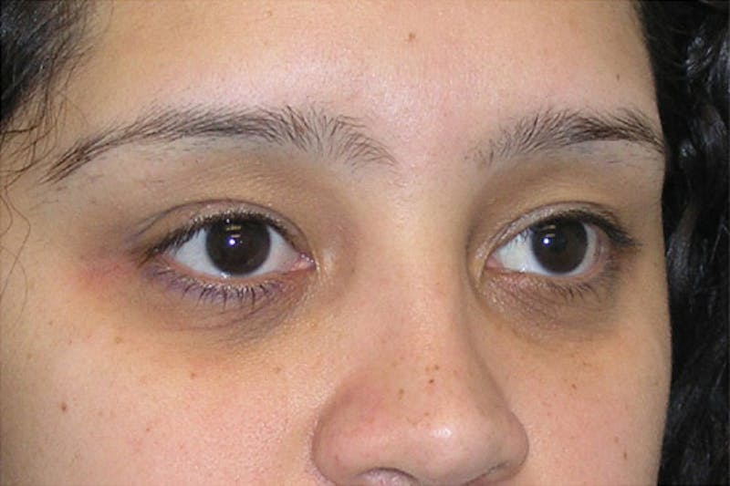 Eyelid Surgery Before & After Gallery - Patient 117908 - Image 3
