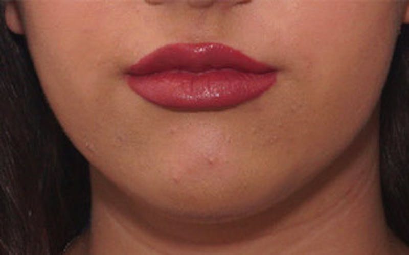 Chin Surgery Before & After Gallery - Patient 184973 - Image 6