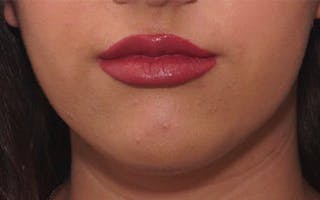 Chin Surgery Before & After Gallery - Patient 184973 - Image 6