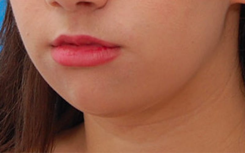 Chin Surgery Before & After Gallery - Patient 184973 - Image 7