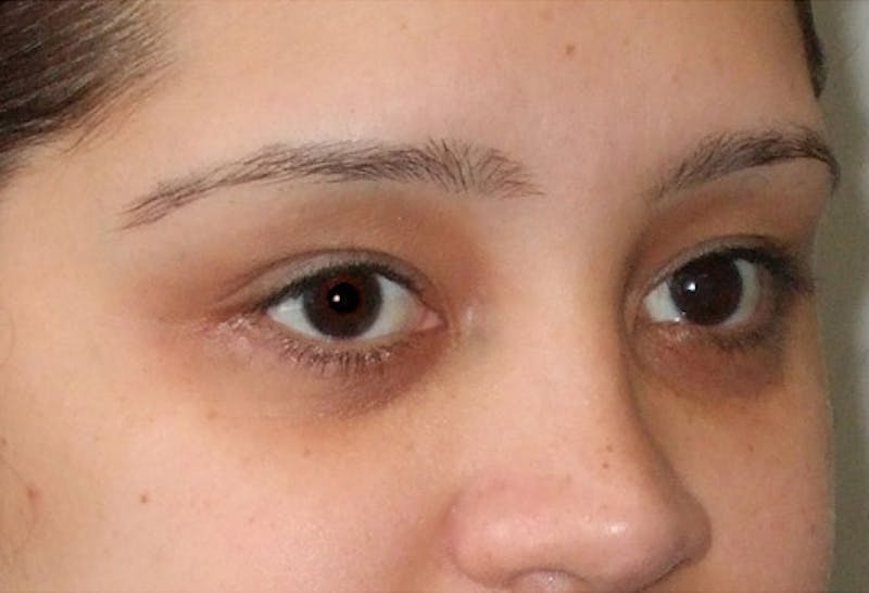 Eyelid Surgery Before & After Gallery - Patient 117908 - Image 4
