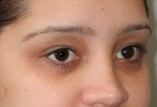 Eyelid Surgery Before & After Gallery - Patient 117908 - Image 4